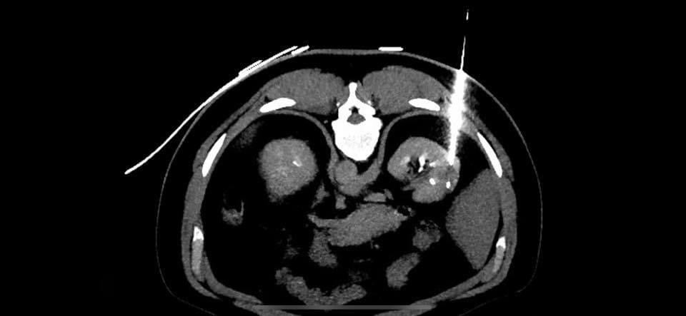 imagem de uma biópsia renal guiada por tomografia computadorizada por um radiologista intervencionista
