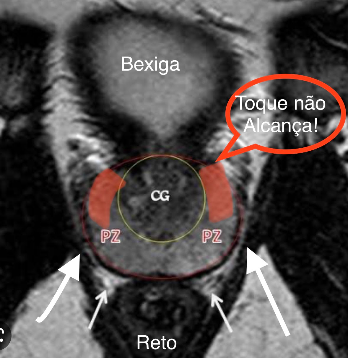 Anatomia da próstata - Sequência T2