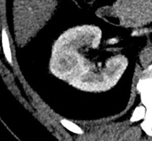 imagem de um nódulo renal no rim direito em exame pós contraste de uma tomografia computadorizada