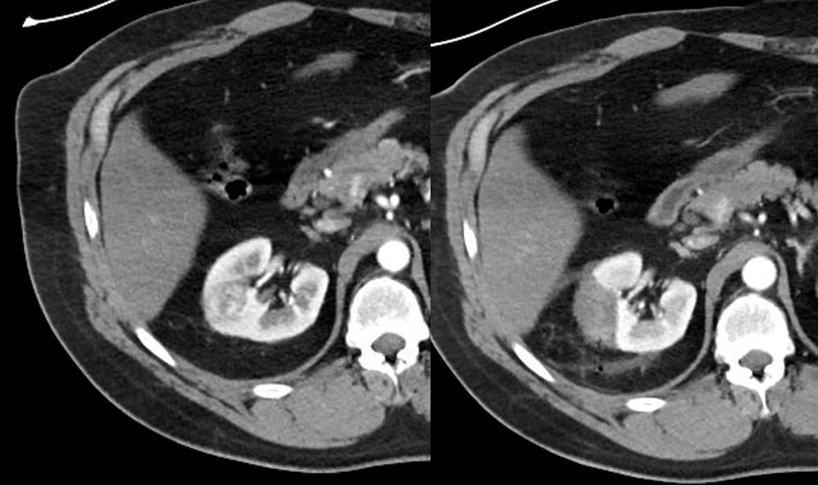Imagens de tomografia computadorizada antes e após tratamento de ablação por radiofrequência de nódulo renal