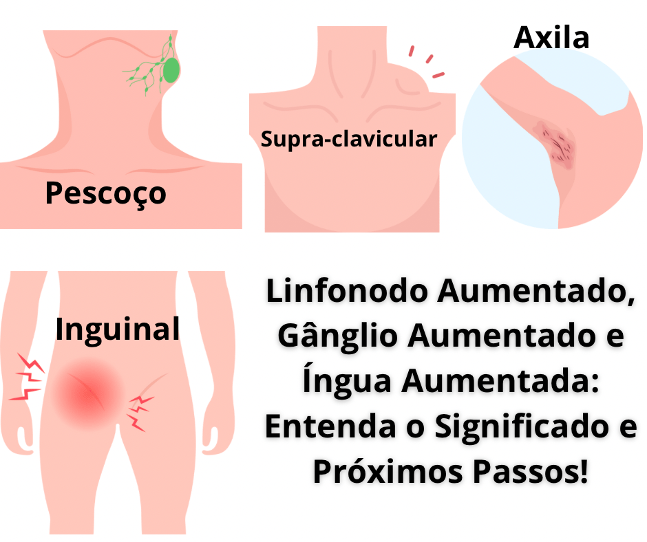 Gânglio e Linfonodo Aumentado, Íngua e Linfonodomegalia! Saiba mais!